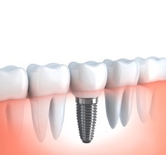 전체임플란트잘하는곳-전체임플란트치과고르는법-전체임플란트가격-시술후기