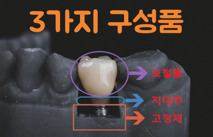 국산-임플란트