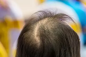 지루성-피부염-완치하려면