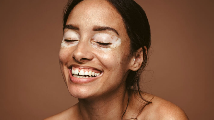 백반증 완벽 가이드