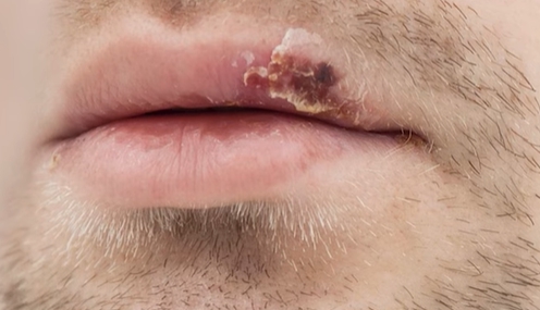 입술 수포 원인