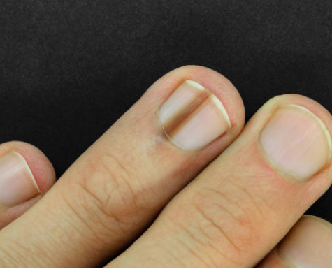 혹색종 손톱사진