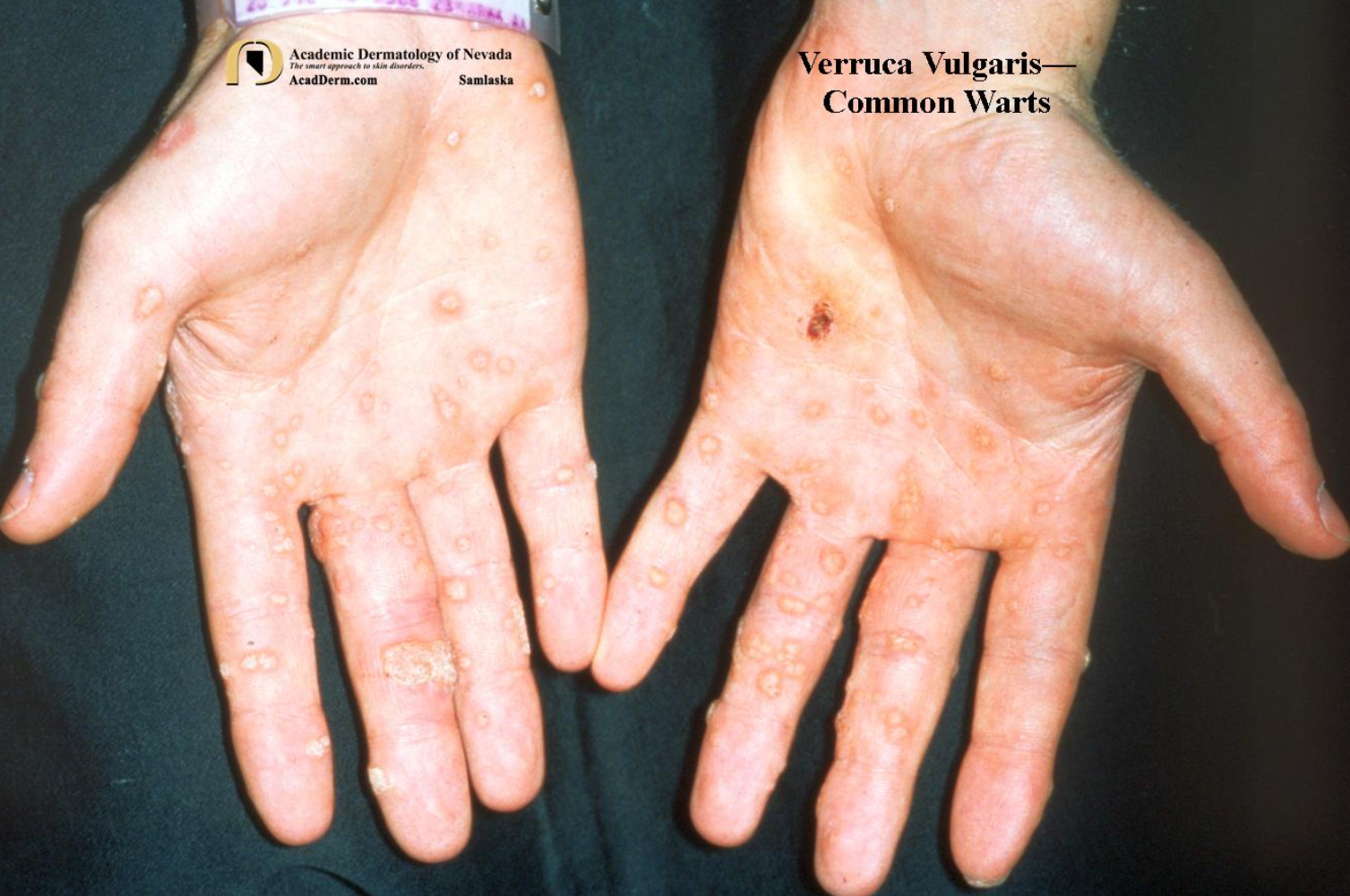 편평사마귀 원인&amp;#44; 증상&amp;#44; 치료 및 주의사항