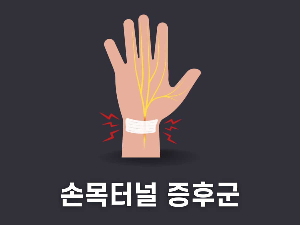 손목터널 증후군