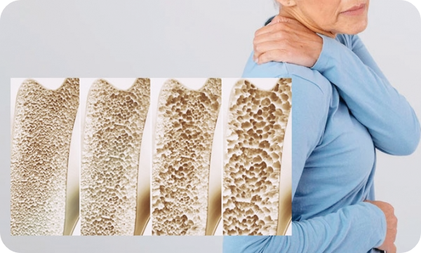 골다공증-치료방법