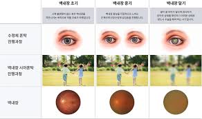 백내장 증상과 안과 병원 추천