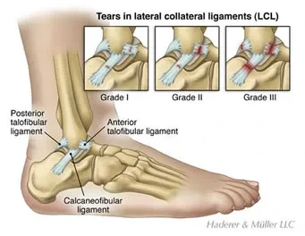 발목 염좌 치료