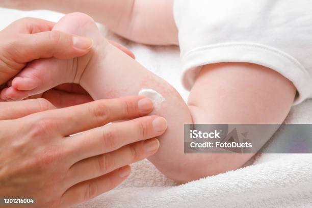 땀띠 관련 사진