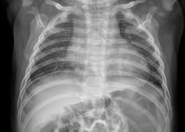 신종인간코로나바이러스 증상