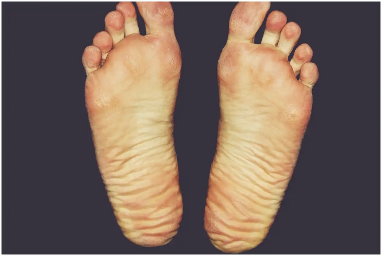 족저 근막염 신발 깔창 추천 및 선택 가이드