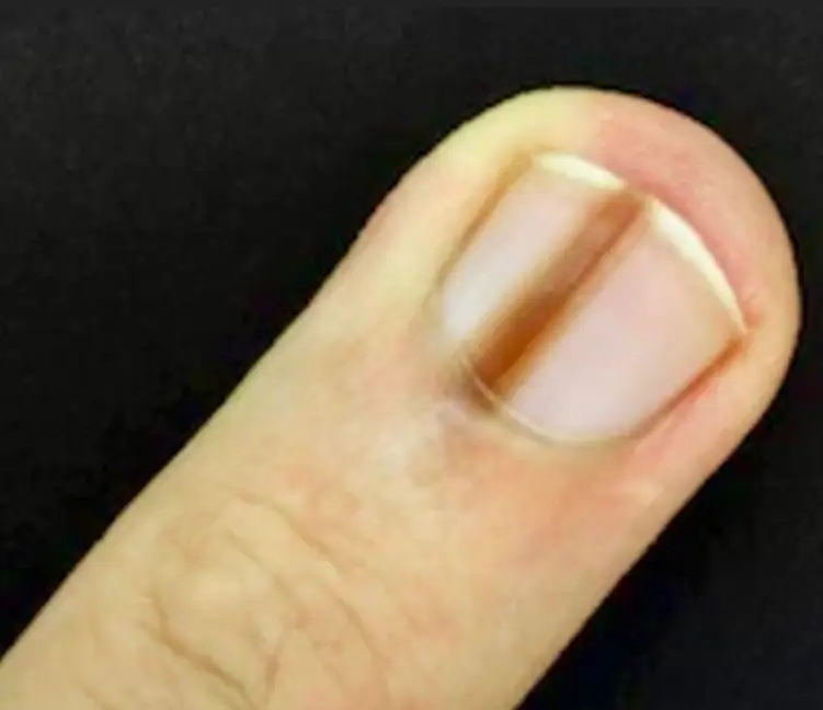 손톱에 검은 세로줄이 생기는 이유