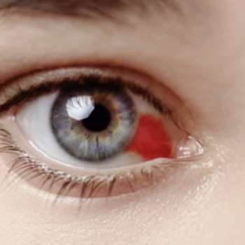 눈혈관 터지는 이유