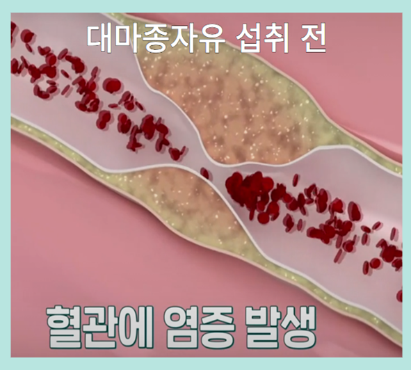 대마종자유 - 섭취 전 뇌혈관 염증