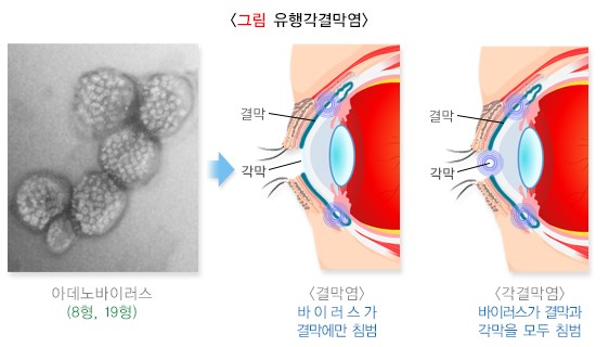 유행성결막염 원인 증상 전염 및 치료방법 알아보기
