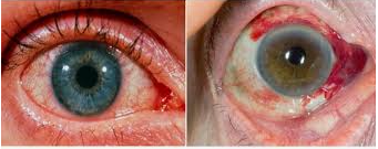 포도막염 증상&amp;#44; 원인&amp;#44; 예방&amp;#44; 치료방법 총정리