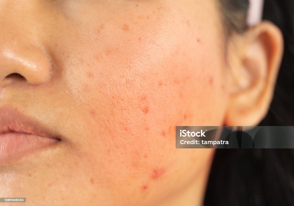 갱년기 홍조 증상의 원인과 해결법 정리