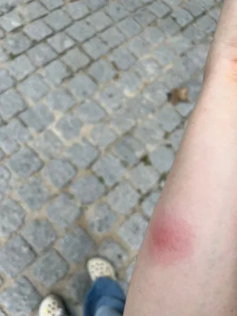 모기 물려 가려울 때 땀띠에 안티푸라민 연고 효능 부작용 사용후기_33