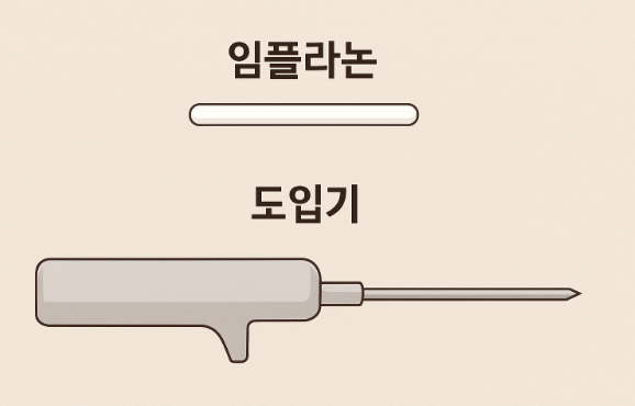 임플라논과-도입기
