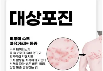 경기도 대상포진 무료접종 연령 기준 정리로 안내_22