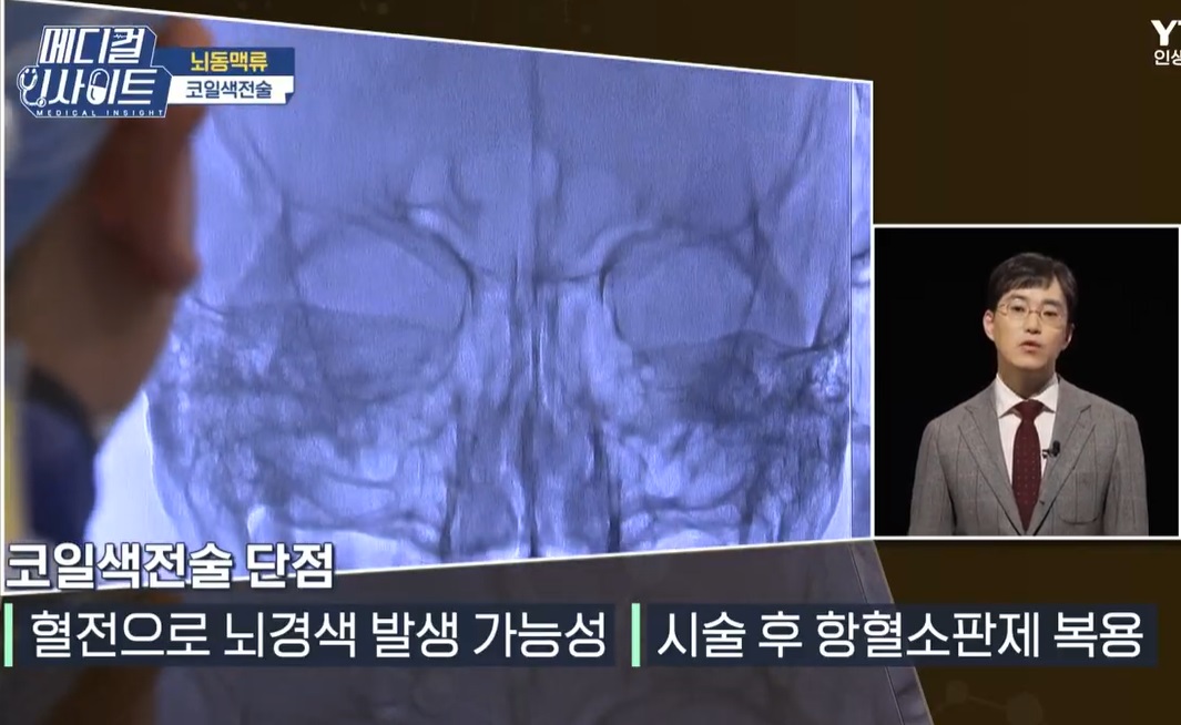 뇌동맥류-코일색전술