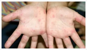 수족구 초기 증상 어른 감염 격리기간 예방 치료 완전 가이드_10