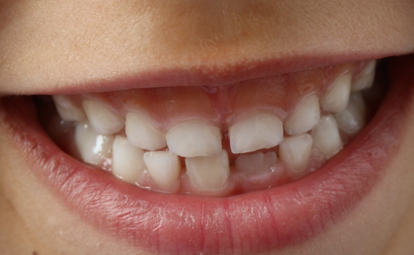 어린이 치아 관리 방법