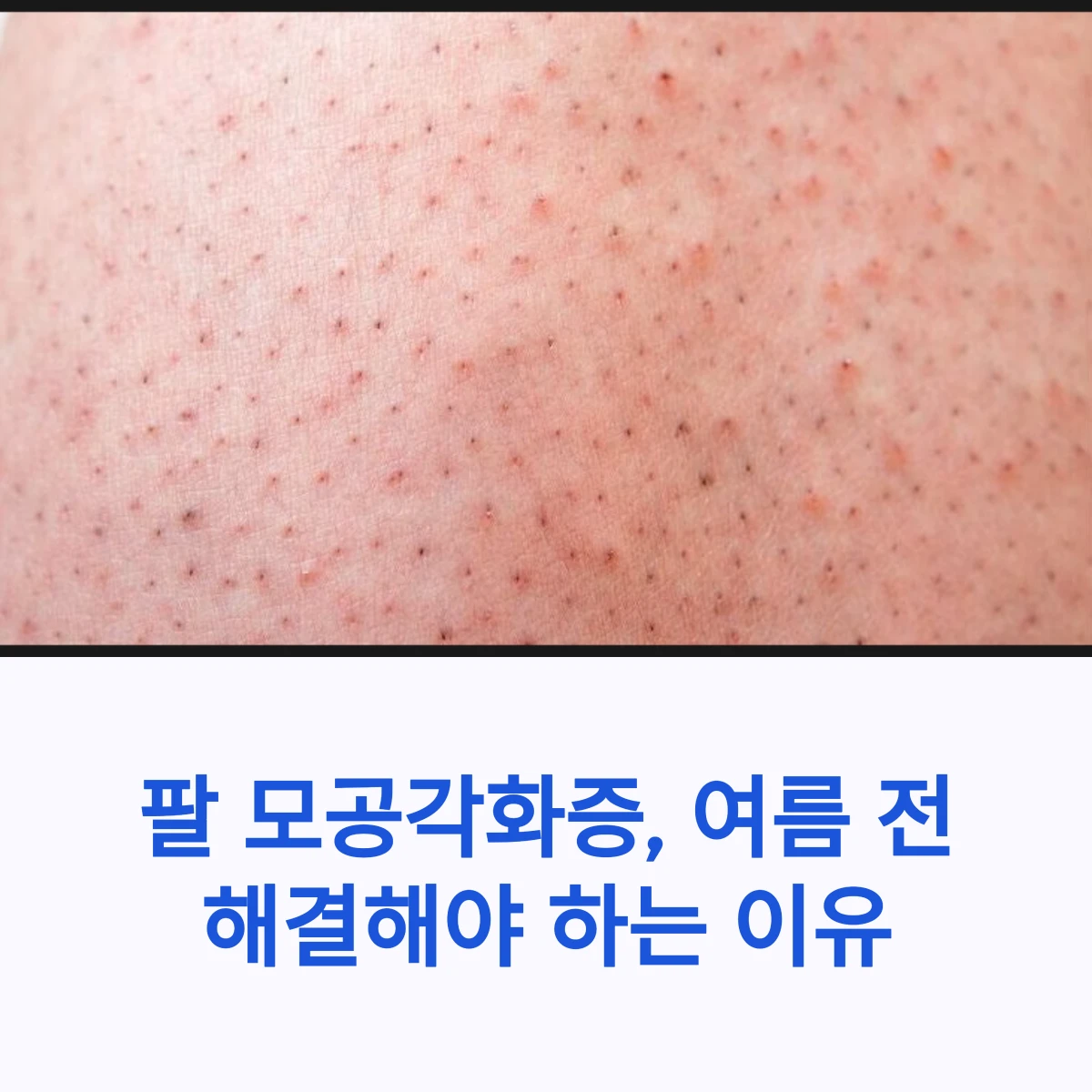 팔-모공각화증-썸네일