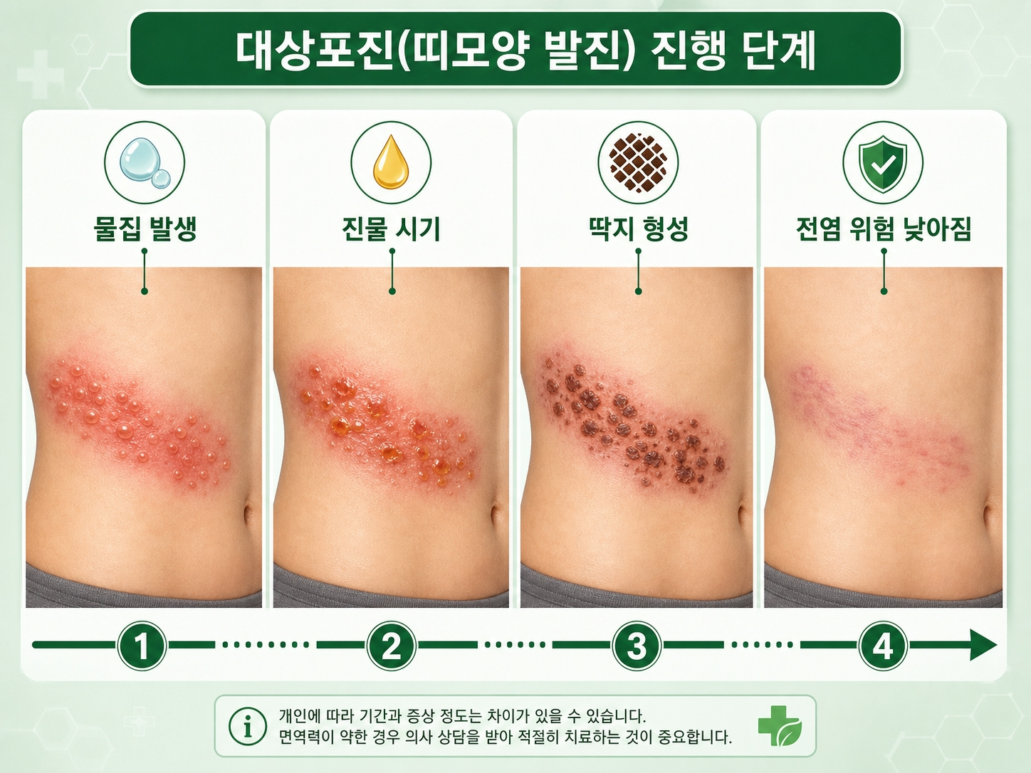 대상포진 전염 기간 물집 딱지 단계