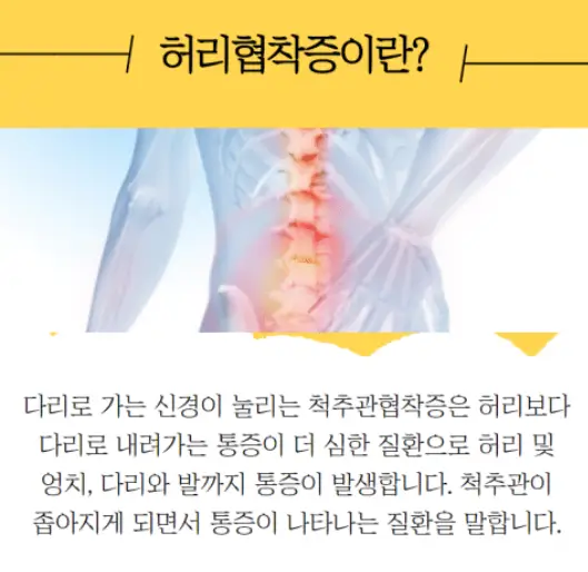 허리협착증