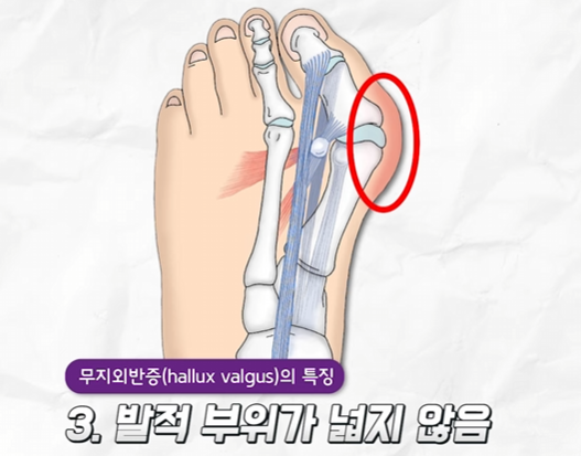 무지외반증3