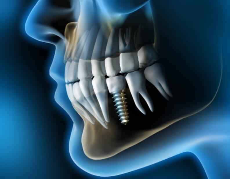 임플란트 잇몸뼈