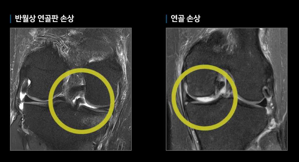 관절염 초기증상