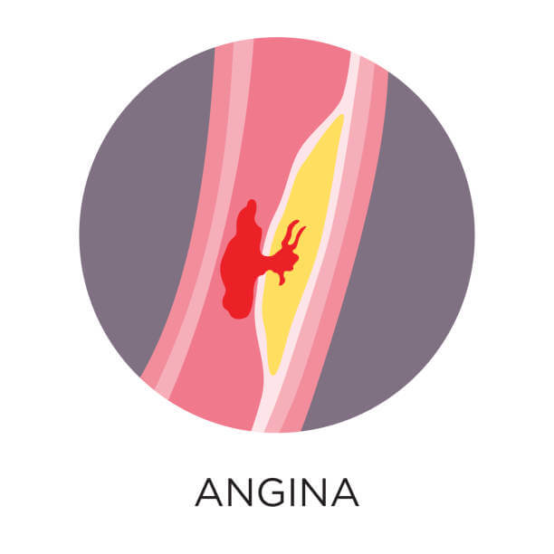 왼쪽가슴통증을 유발하는 흉부 심장통증 원인에는 기본적으로 심장이 있기 때문에 심장 문제라고 생각합니다. 평소에 왼쪽가슴통증이 있을 때도 심장에 이상이 있는 것 같고 무섭다는 생각이 들 수도 있습니다. 그러나 왼쪽 가슴 통증이 모두 심장의 문제는 아니고 역류성식도염 등 심장, 폐, 소화기 질환 등 다양한 질환을 예측할 수 있습니다.
