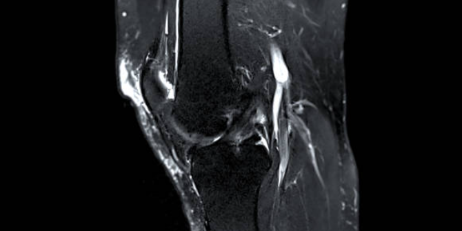 내측 인대 손상