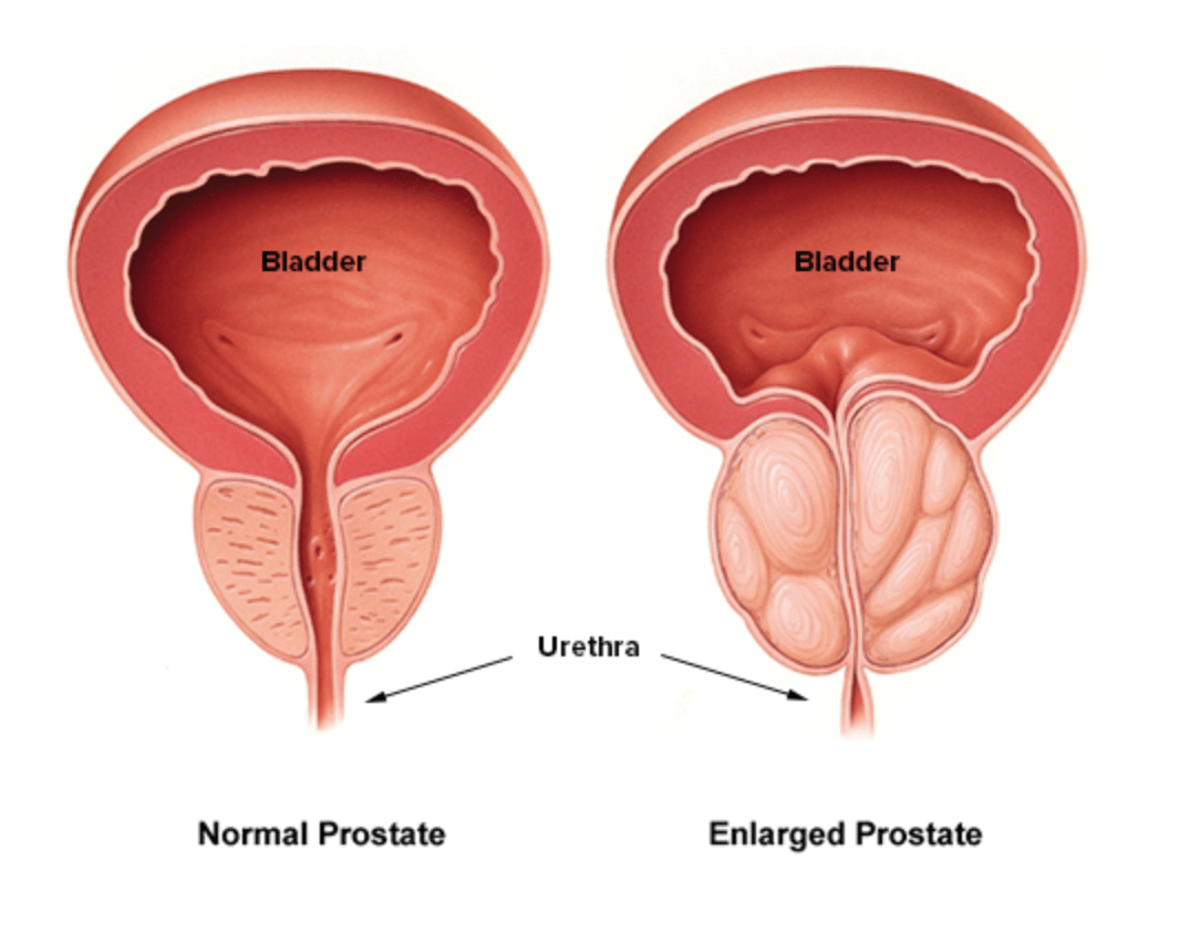 전립선 비대증 증상