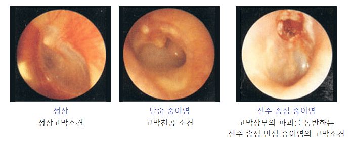 만성중이염