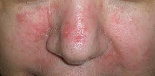 지루성 피부염 완치하려면