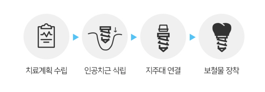 임플란트 가격