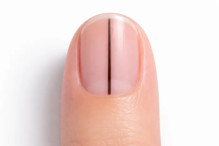 손톱에 세로줄이 생기는 이유