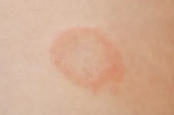 얼굴 버짐 증상 없애는 실전 방법 5가지 및 관리요령_9