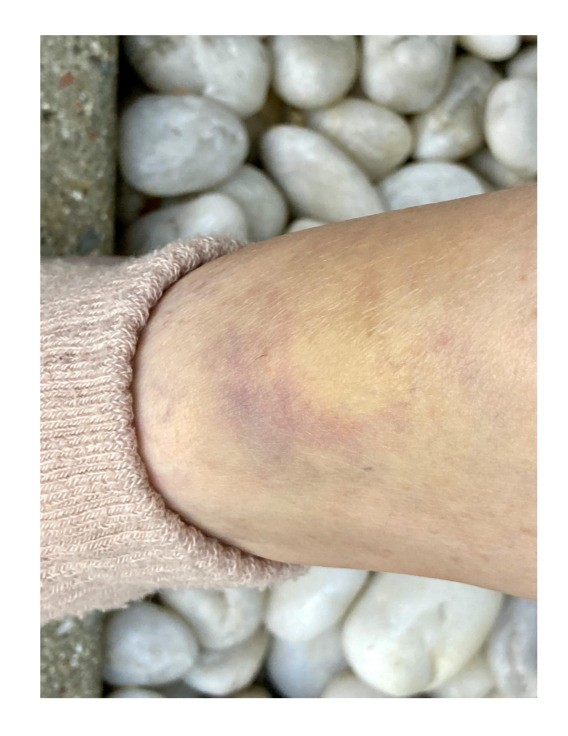 팔에 멍이든 이미지