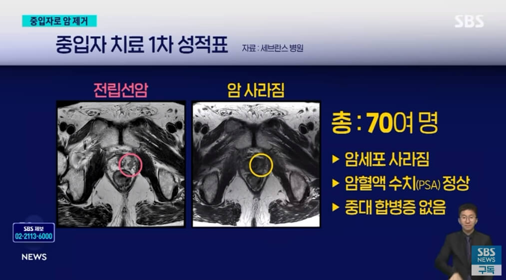 중입자치료-결과