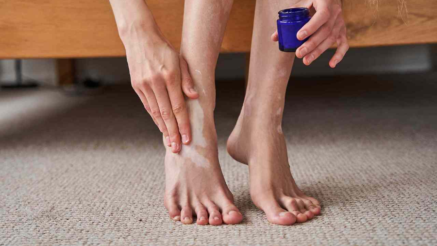 백반증 완벽 가이드