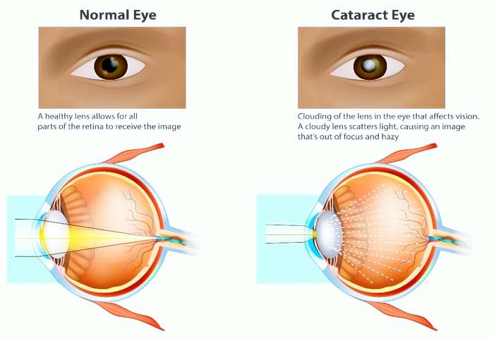 건강-백내장-수술