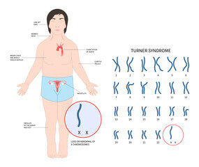 클라인펠터 증후군&amp;#44; 남자가 유방이 나온다면? 대표적인 증상입니다. 클라인펠터 증상은 다양하게 더 있습니다. 어떤 증상과 원인 그리고 진단과 치료에 대해 알아봤습니다. 참고하시기 바랍니다. 