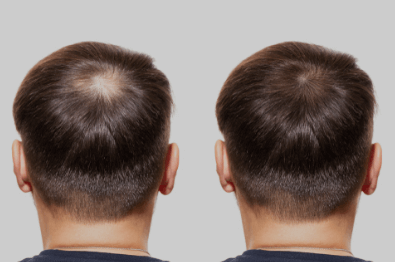 탈모 원인과 예방법, 탈모 예방 샴푸