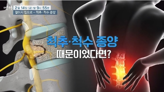 척수척추종양-명의