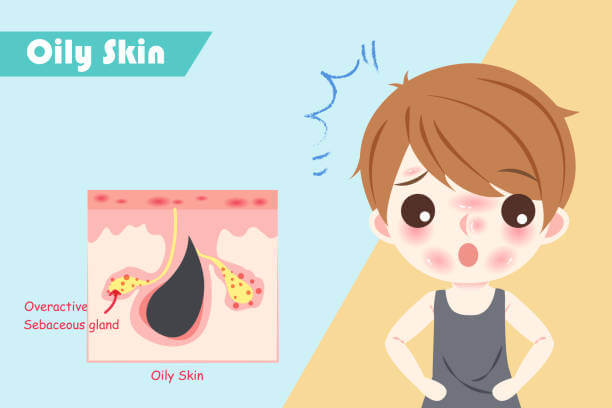지성 피부 (Oily Skin)