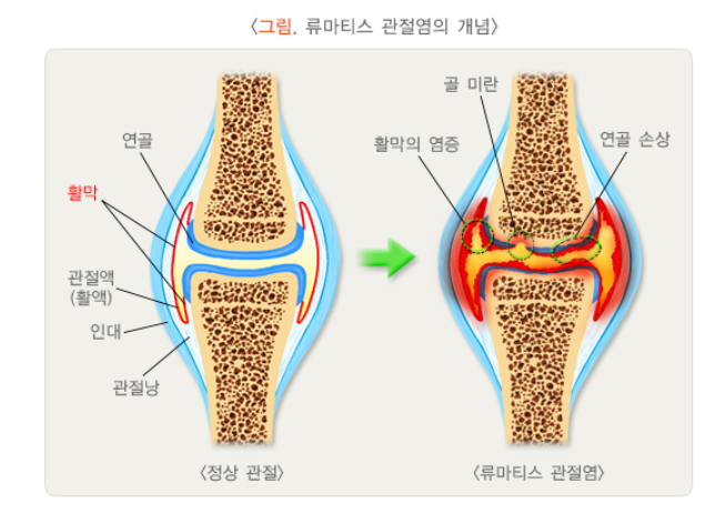 류마티스 관절염이란