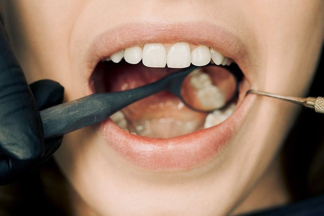 구강 내 임플란트 점검 장면 &ndash; 치아 사이 상태 확인 중